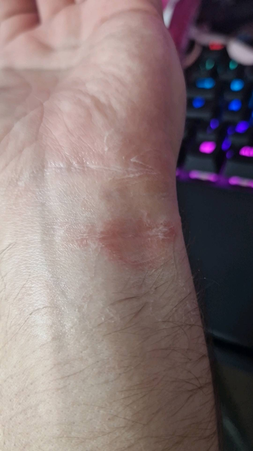 Skin issue from a watch | WatchCrunch